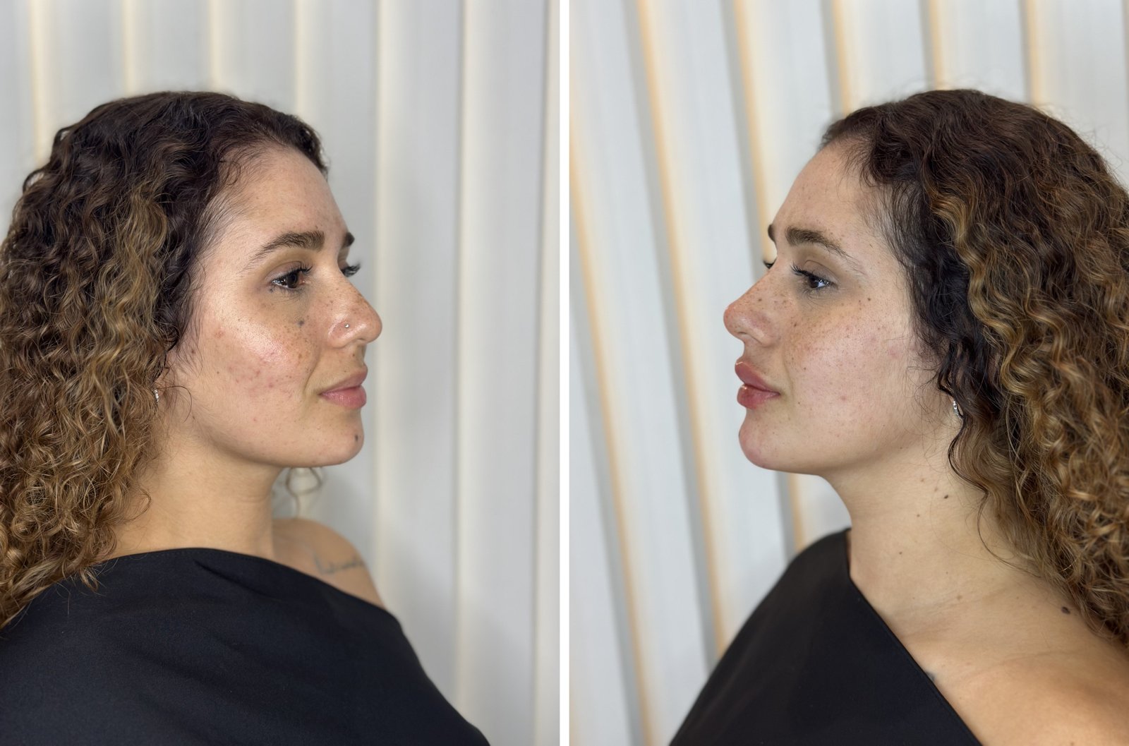 Antes e depois — caso 1