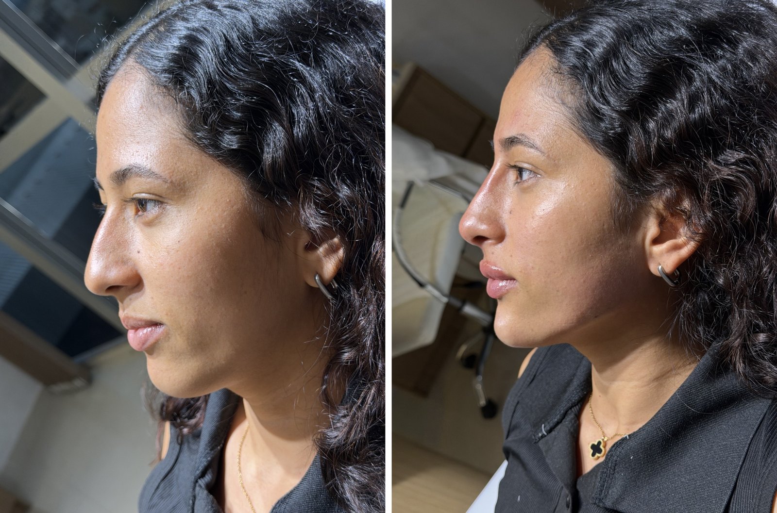 Antes e depois — caso 2