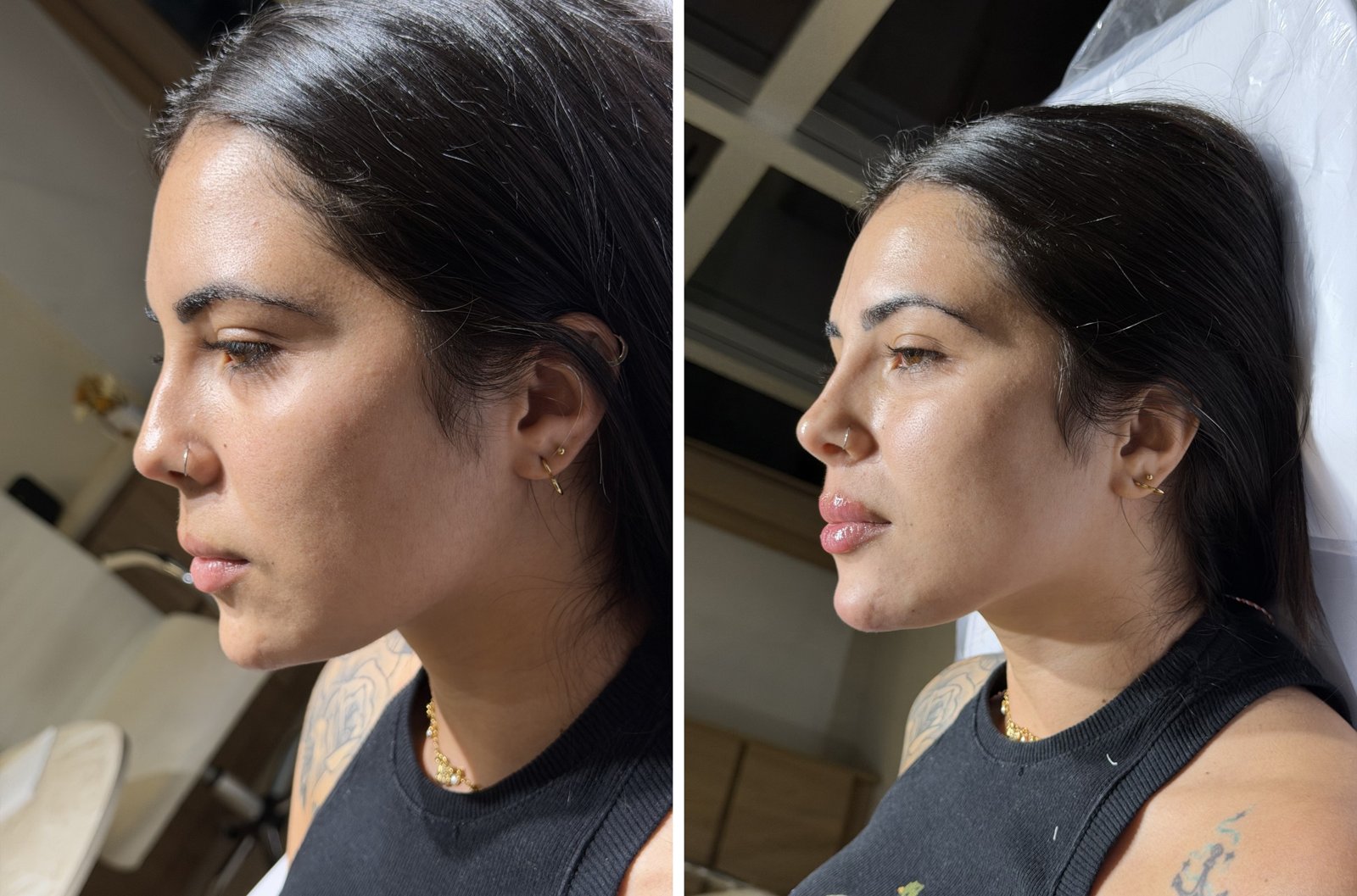 Antes e depois — caso 5